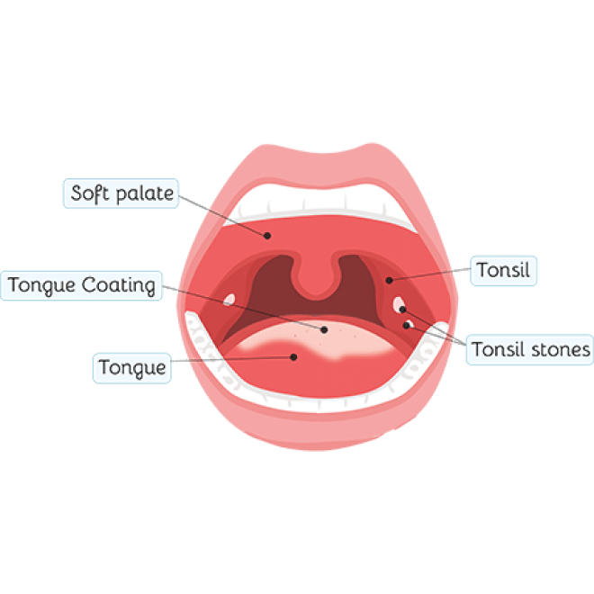 tonsillitis-all-that-you-should-know-living-herself